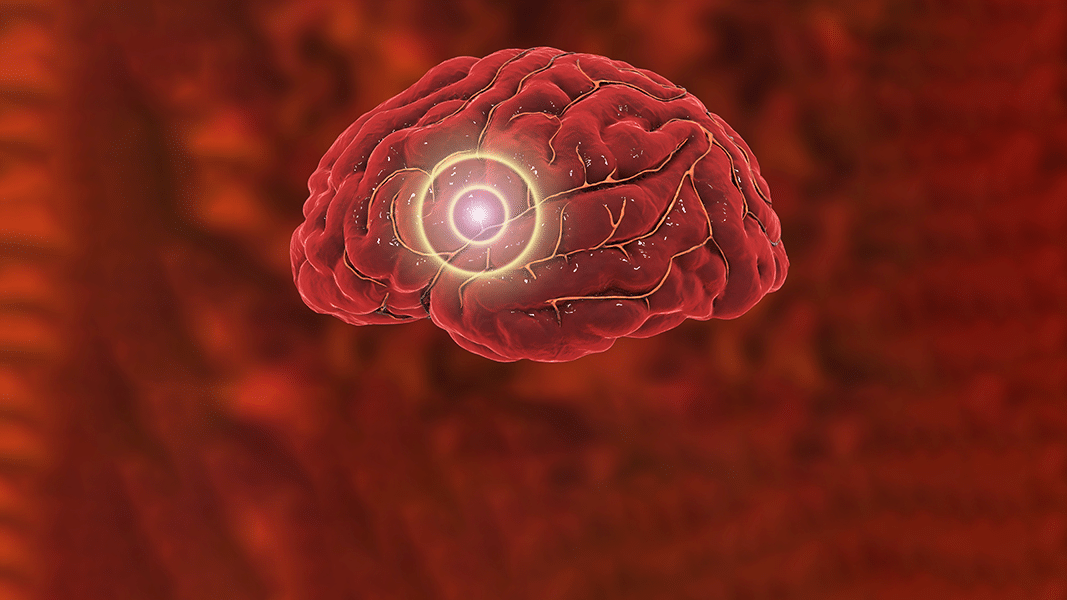 brain with stroke